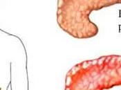 Pancreatitis aguda