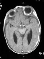 La Ventriculomegalia Cerebral