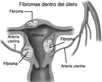 fibromas-dentro-del-utero Los fibromas y lo que se necesita saber