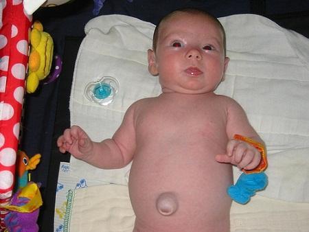 Los bebés prematuros son más proclives a desarrollar hérnias umbilicales