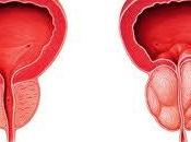 prostatitis