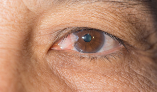 La cirugía de pterigión.