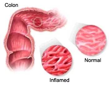 ALIMENTOS A EVITAR SI AQUEJA SÍNDROME DEL INTESTINO IRRITABLE