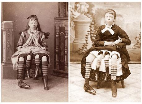 La niña de las cuatro piernas