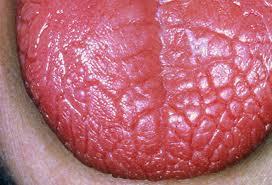 El problema de la boca seca