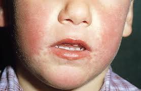 eritemainfeccioso ¿Sabes qué es el eritema infeccioso?