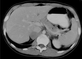 El tumor feocromocitoma