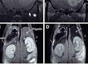 Resonancia Magnética Metabólica