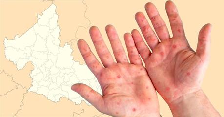 Identifican tres casos de lepra en San Luis Potosí