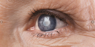 ¿Pueden prevenirse las cataratas?