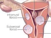 Opciones tratamiento para fibromas uterinos