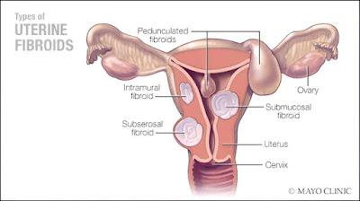 Opciones de tratamiento para los fibromas uterinos