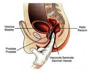 El cáncer de próstata tiene causas multifactoriales: Mauricio Cantellano
