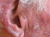 Tratar dermatitis seborreica