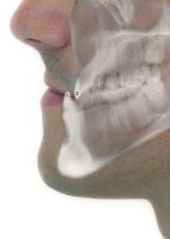 Qué es el prognatismo