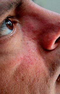 La rosácea es una enfermedad crónica que puede deformar el rostro