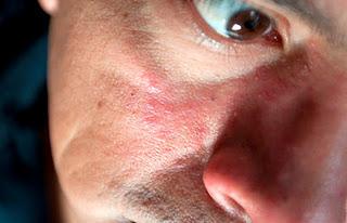 La rosácea es una enfermedad crónica que puede deformar el rostro