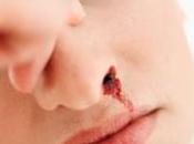 ¿Por sangra naríz?