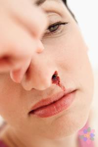 ¿Por qué sangra la naríz?