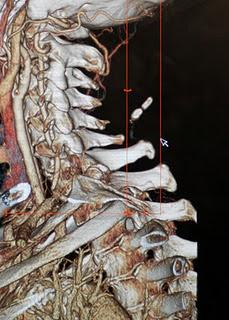 Tomar ácido fólico tres meses antes de embarazarse evita trastornos de espina bífida: IMSS
