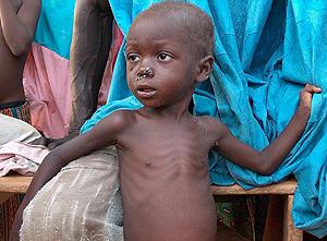 Diferencias entre malnutrición y desnutrición