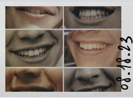 Como borrarlas evitarlas argentina tratamiento Arrugas nasogenianas marioneta