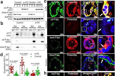 Científicos están cerca de lograr la cura de la preeclampsia