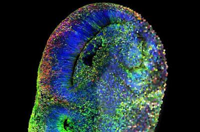 Exámenes cerebrales identifican alteraciones que llevan al autismo