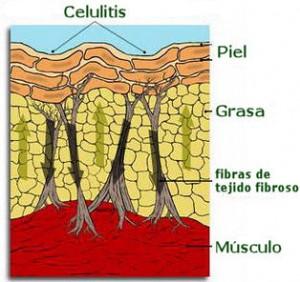 CELULITIS JOVEN O VIEJA, ¿CUÁL TIENES TÚ?