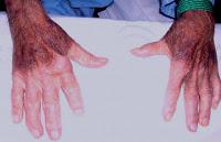 El Síndrome Antisintetasa