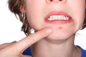 Los granitos y el acné no afectan solo a los jóvenes …