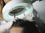 Ozonoterapia Capilar