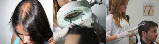 Ozonoterapia Capilar