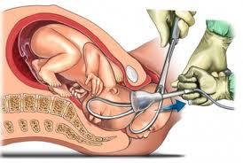 Sobre el parto con fórceps y menos riesgo de lesión cerebral en bebés