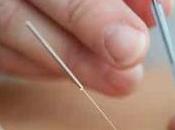 ¿Cómo acupuntura puede ayudar migrañas?