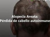 Alopecia Areata: pérdida cabello autoinmune
