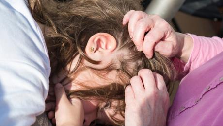 Evitar el contagio de piojos y eliminarlos de manera natural