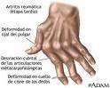 Más de 300 especialistas de todo el mundo apuestan en Sevilla por el diagnóstico precoz y el tratamiento temprano de la artritis reumatoide