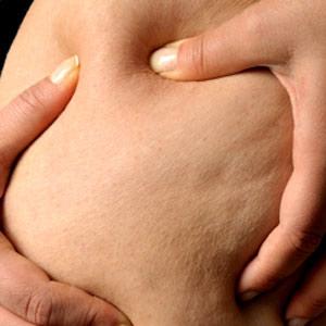 DEFINITIVAMENTE SIN CELULITIS