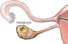 Los quistes de ovario y el embarazo