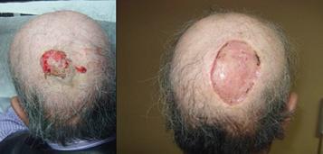 Siringocistoadenocarcinoma Papilifero