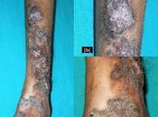 Angioqueratoma circunscripto neviforme