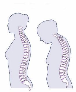 La importancia de la rehabilitación en los pacientes con Espondilitis Anquilosante
