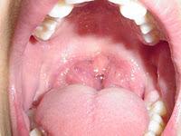 Operar de amígdalas. Si, no y cuándo