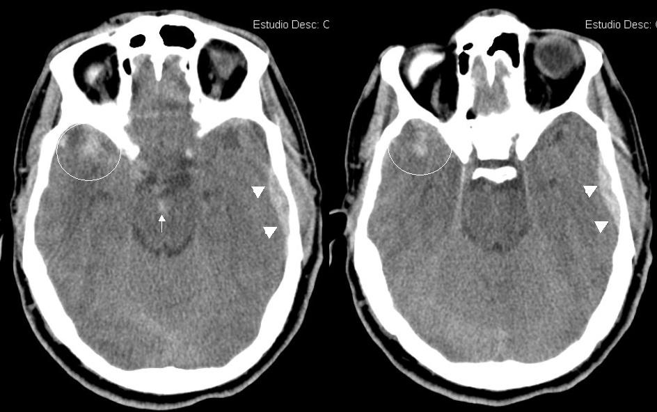 Sensibilidad de la TAC dentro de las seis horas del inicio de la cefalea para el diagnóstico de hemorragia subaracnoidea