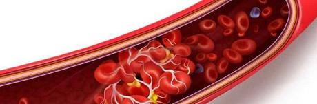 Trombosis venosa: qué es, síntomas y cómo tratarla vena atascada