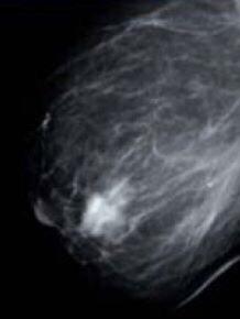 Caso clínico mamografía