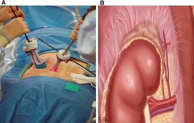 Abordajes para adrenalectomía