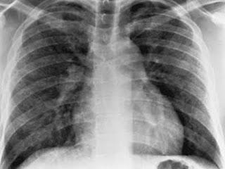 Complicaciones cardíacas de la neumonía adquirida en la comunidad (NAC)
