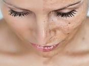 Cloasma melasma